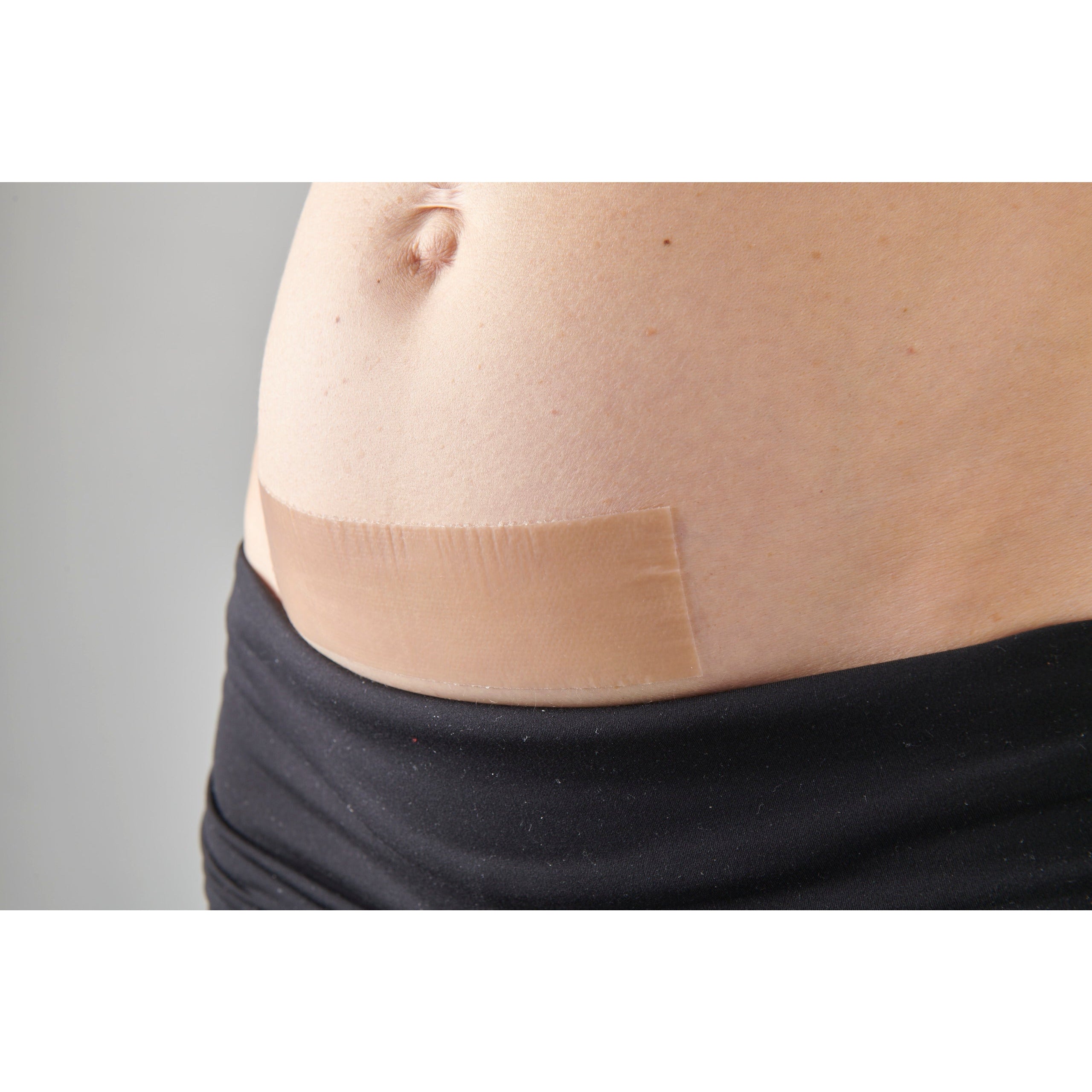 My Scar Active Caesarean Silicone Wound Healing Strips